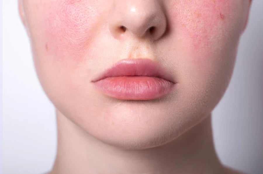 Skincare Mythbusting for Redness-Prone Skin: Debunking Misconceptions with Evidence-Based Explanations