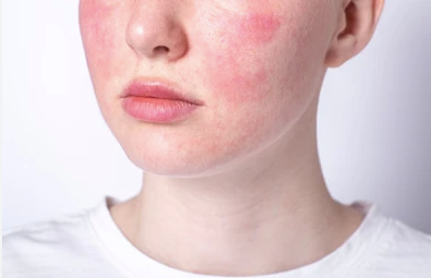 A Comprehensive Guide to Rosacea Subtypes and Symptoms