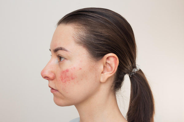Rosacea and Hormonal Influences: Understanding Flare-Ups and Managing Hormonal Changes